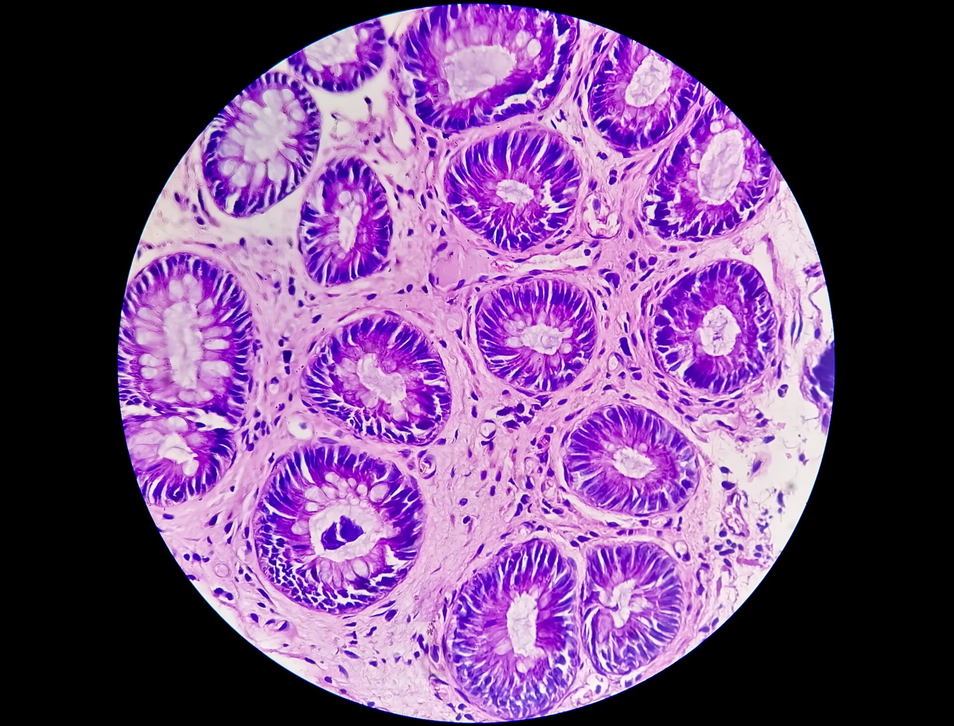 Photomicrograph,Of,Rectal,Cancer.,Microscopic,Slide,View.,Ibd.,Ibs.