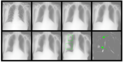 Figure 1:Automatic identification of lung opacity using latent traversals
