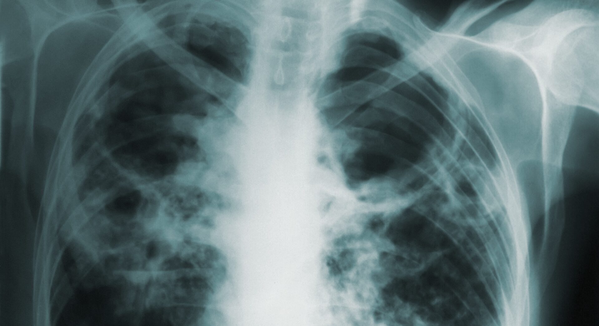 Explainable identification of lung abnormalities in chest X-ray and CT imaging