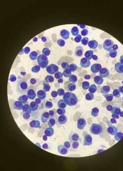 Multiple myeloma